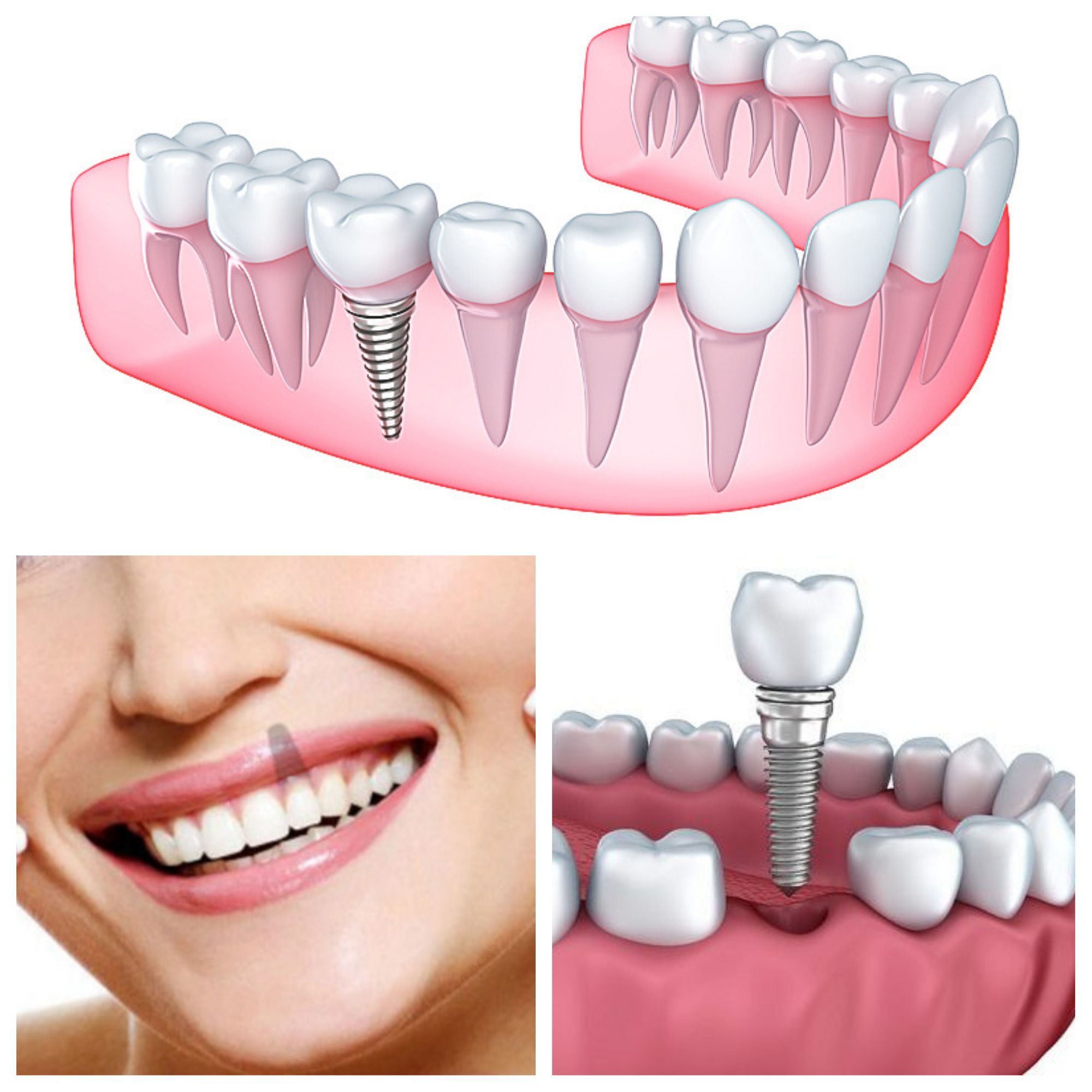 Implantes dentales en un día