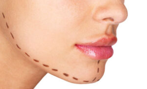 Mentoplastia con especialistas