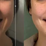 Casos clínicos ORTHOFACIAL brackets