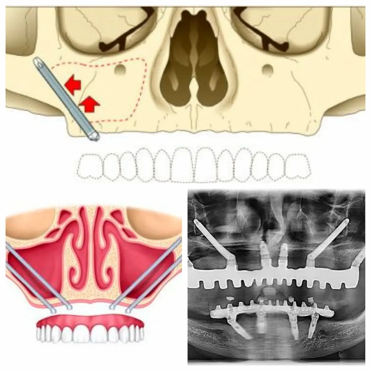 Implantes cigomáticos