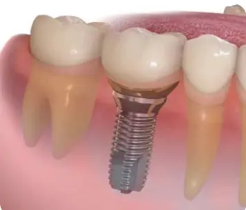 Implantes dentales bilbao