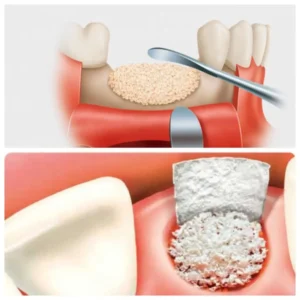 Implante de hueso dental