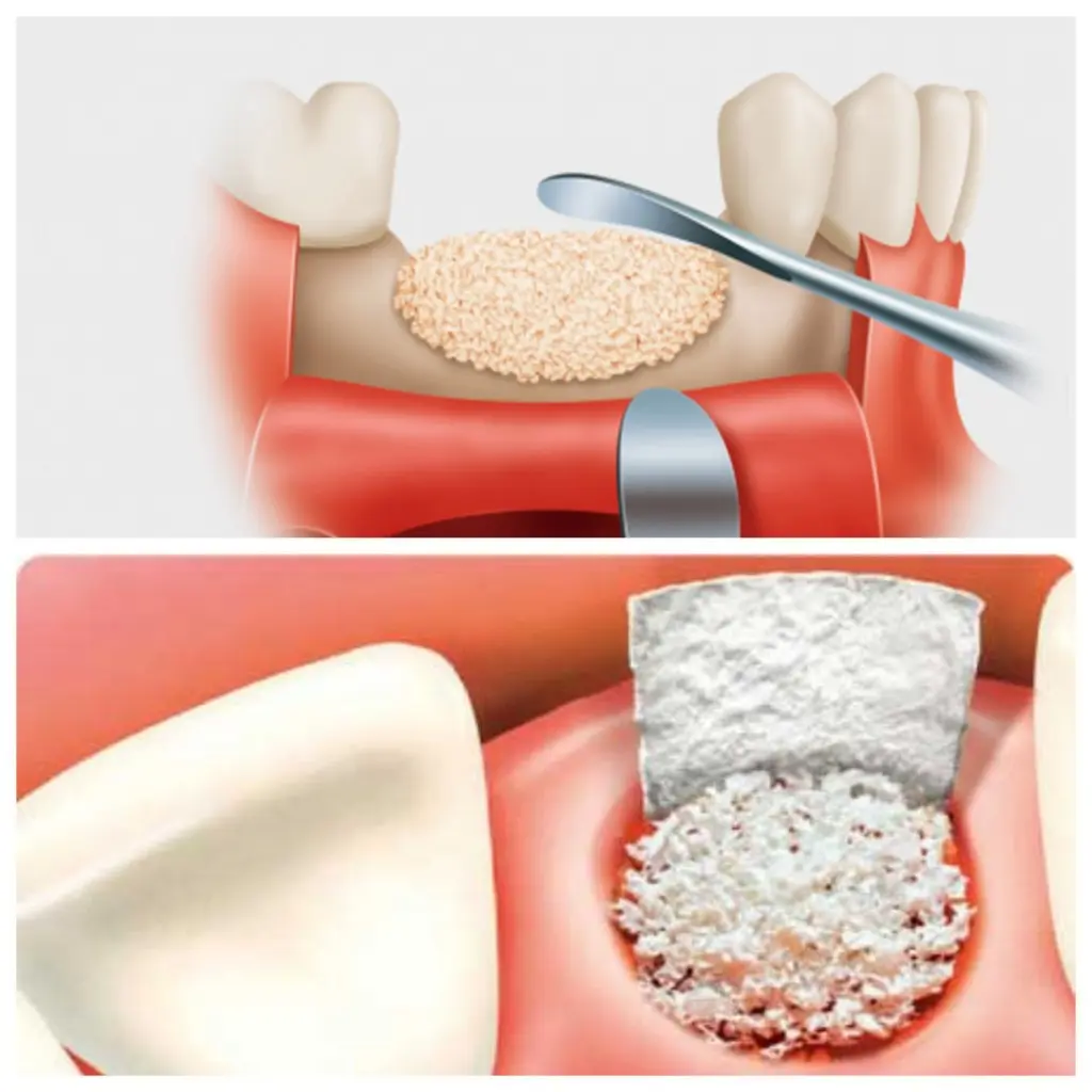 Injerto de hueso dental