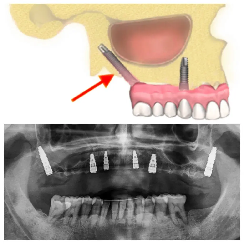 Implantes dentales pterigoideos