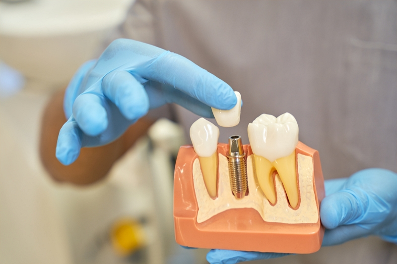 Implantes de carga inmediata