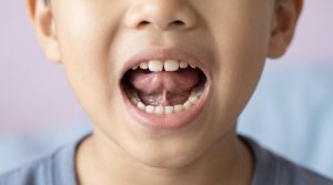 Primer plano de niño con la boca abierta y la lengua elevada que deja ver el frenillo lingual