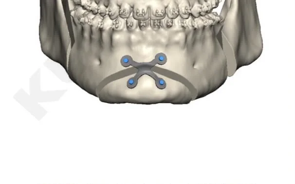 Planificación 3D en vista frontal de una mentoplastia con placa de titanio personalizada